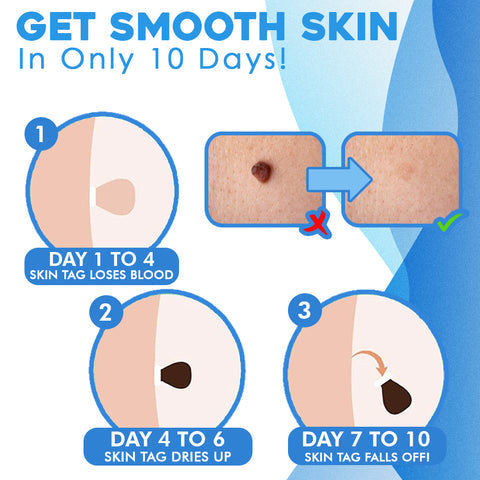 FlawFix™ – Wart Removal Set for Gentle, Effective & Safe Removal [50% Off]