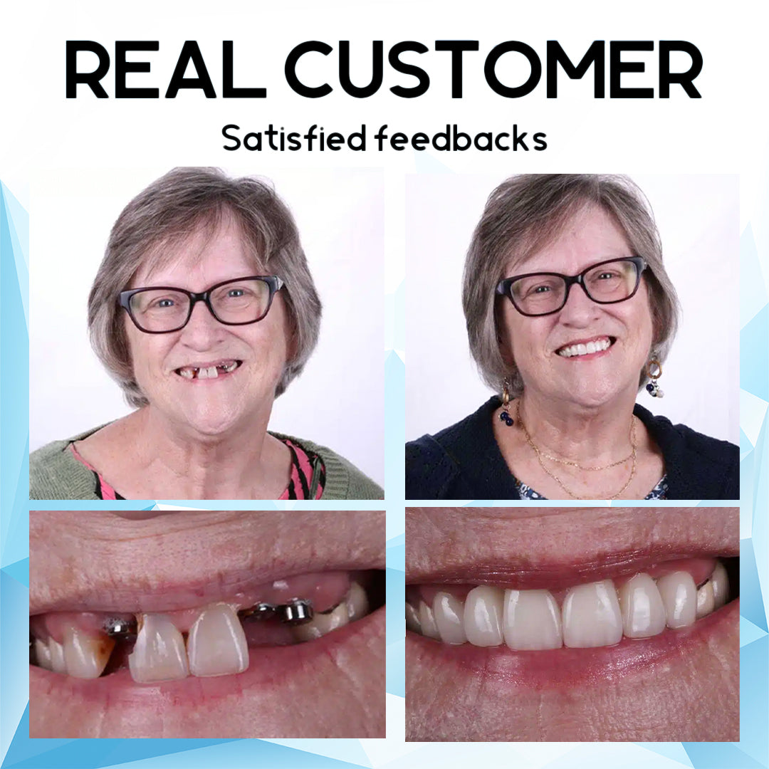 Silicone Reline Denture Set | Secure Denture Fit | BrightFit Veneer