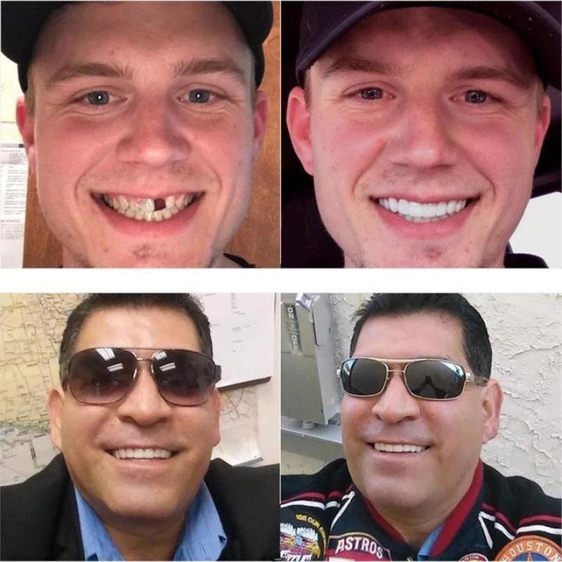 SnapOn™ – Clip-On Denture for a Radiant Smile [1 + 1 Free]