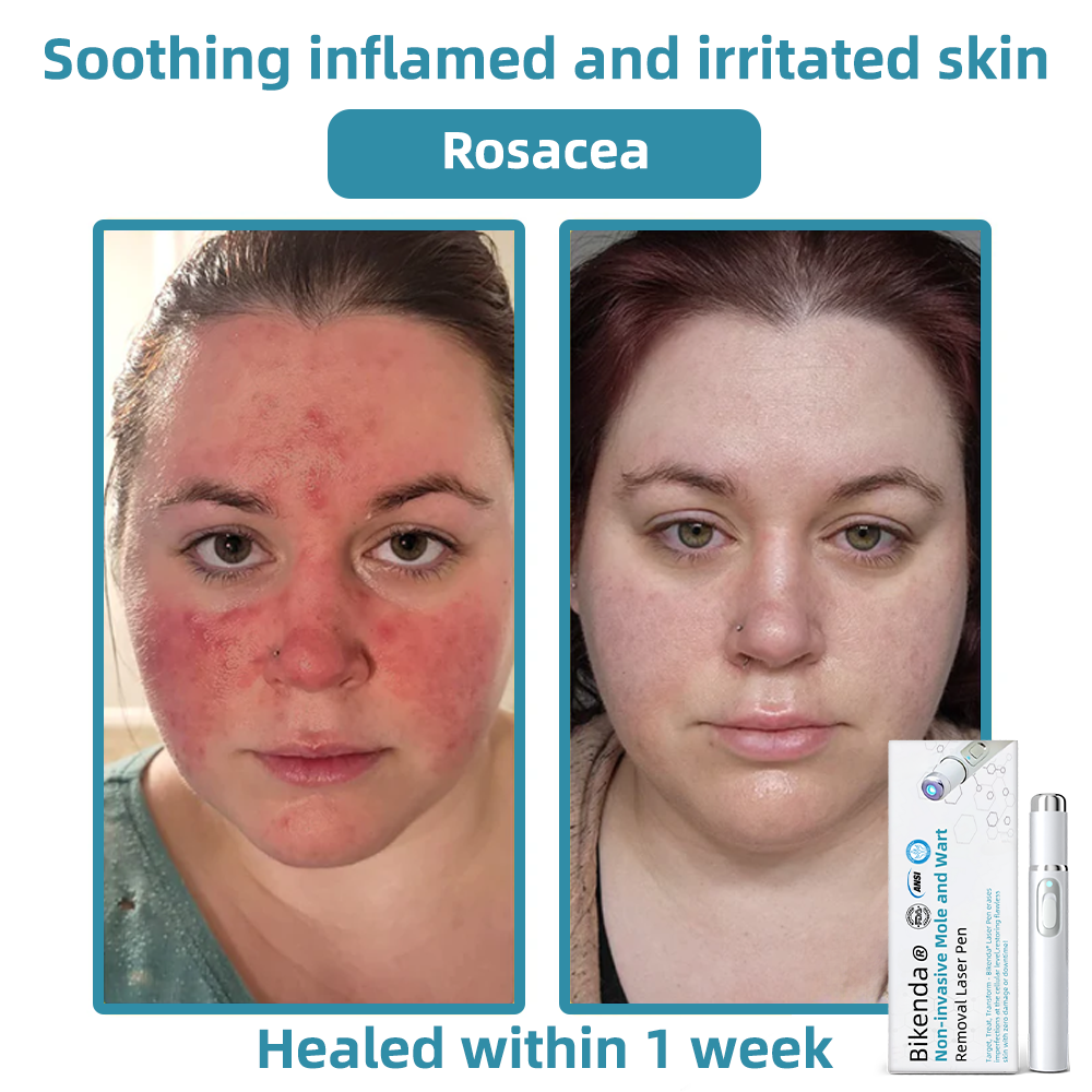 CO2 Laser Pen for Skin Blemish Removal – At-Home Precision Spot Treatment