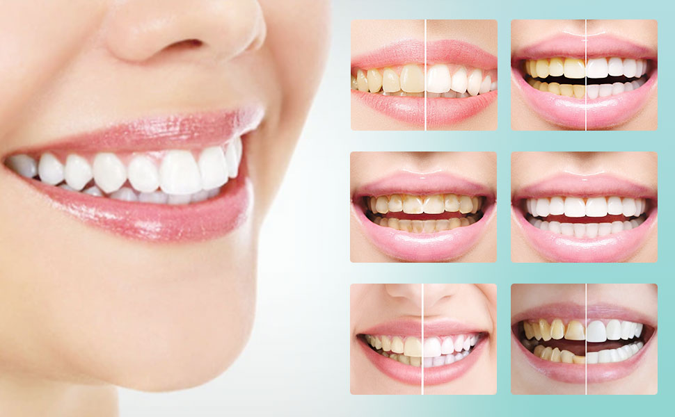Teeth Whitening Foam Toothpaste – Gentle Stain Removal for Brighter Teeth