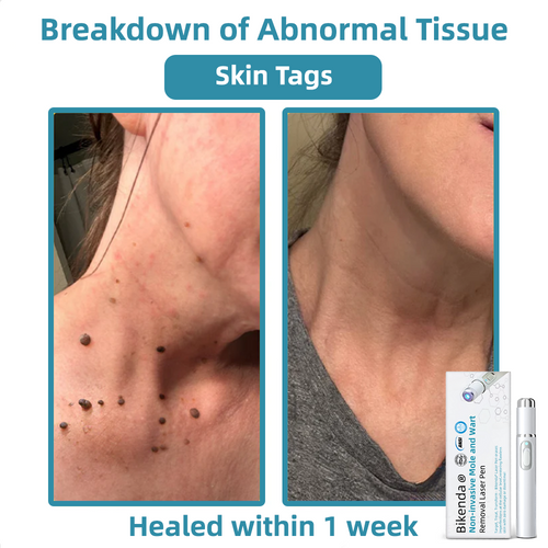 CO2 Laser Pen for Skin Blemish Removal – At-Home Precision Spot Treatment