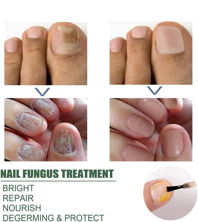 Nail Repair Serum for Discolored & Brittle Nails – Daily Care Formula