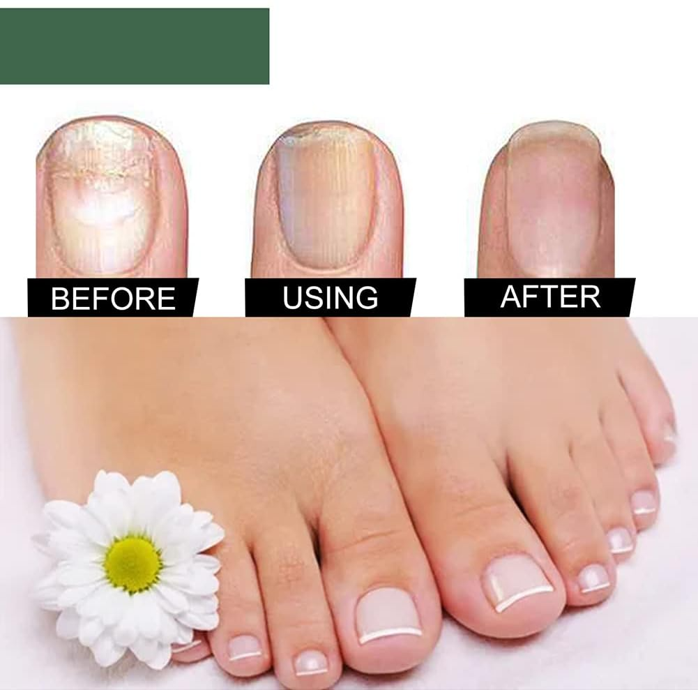 Nail Repair Serum for Discolored & Brittle Nails – Daily Care Formula