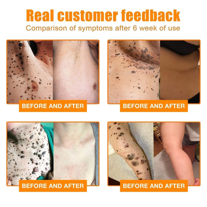 NewYou™ TagLift Bee Venom Treatment – Painless Skin Renewal for Clear and Confident Skin [1 + 1 Free]
