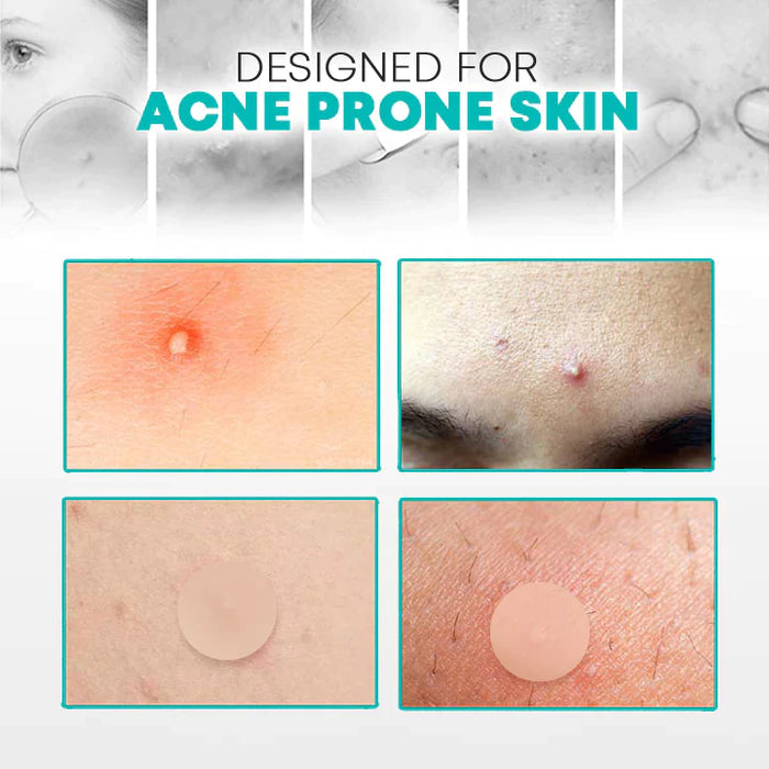 AcNatch – Patches for the Removal of Acne and Skin Imperfections for Clear Skin [50% Discount]