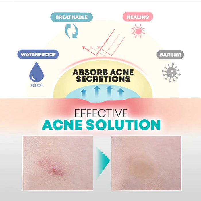 AcNatch – Patches for the Removal of Acne and Skin Imperfections for Clear Skin [50% Discount]
