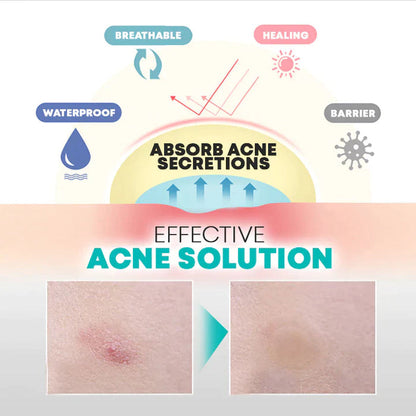 AcNatch – Patches for the Removal of Acne and Skin Imperfections for Clear Skin [50% Discount]