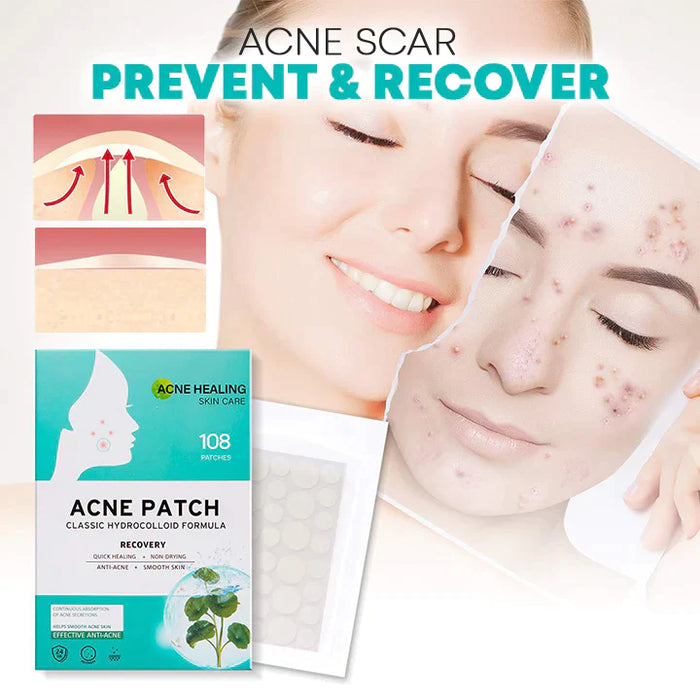 AcNatch – Patches for the Removal of Acne and Skin Imperfections for Clear Skin [50% Discount]