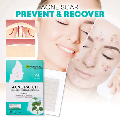 AcNatch – Patches for the Removal of Acne and Skin Imperfections for Clear Skin [50% Discount]