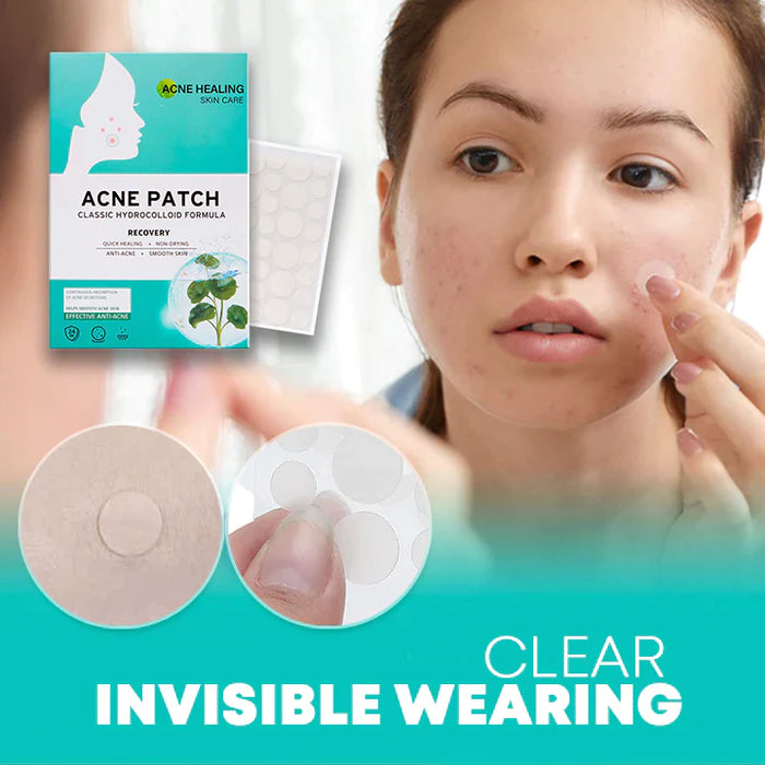 AcNatch – Patches for the Removal of Acne and Skin Imperfections for Clear Skin [50% Discount]
