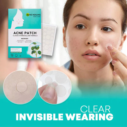 AcNatch – Patches for the Removal of Acne and Skin Imperfections for Clear Skin [50% Discount]