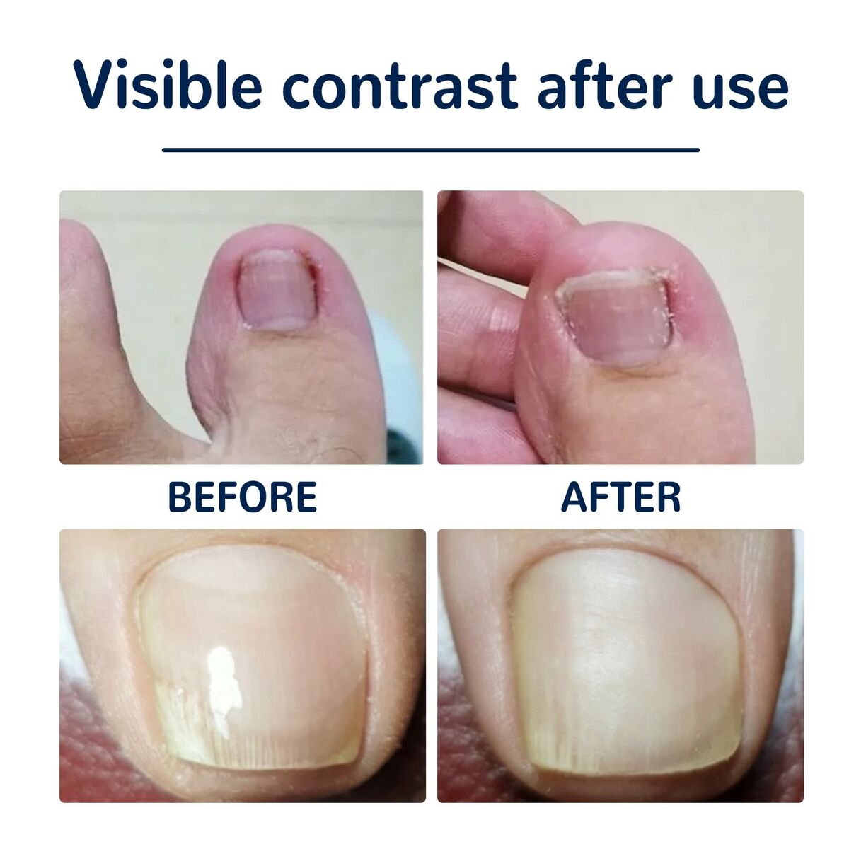 NailLift™ – Correction Pads for Ingrown Toenails: Easy to Use and Protective [Buy 1 Get 1 Free]