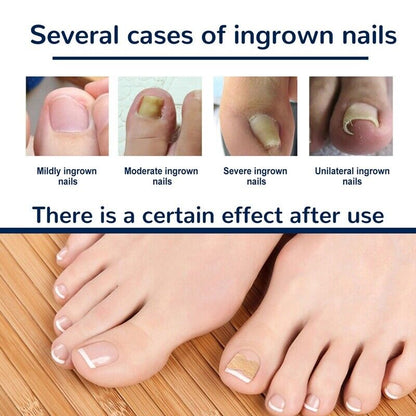 NailLift™ – Correction Pads for Ingrown Toenails: Easy to Use and Protective [Buy 1 Get 1 Free]