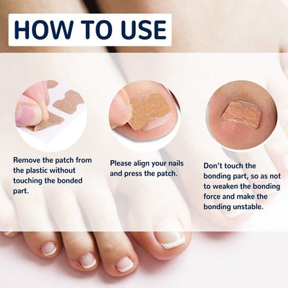 NailLift™ – Correction Pads for Ingrown Toenails: Easy to Use and Protective [Buy 1 Get 1 Free]