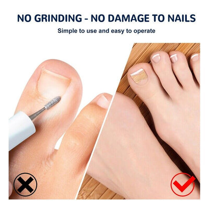 NailLift™ – Correction Pads for Ingrown Toenails: Easy to Use and Protective [Buy 1 Get 1 Free]