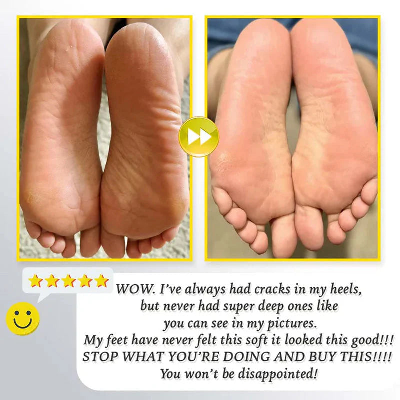 Gleam™ – Gentle Callus Remover for Smooth & Soft Feet [50% Off]