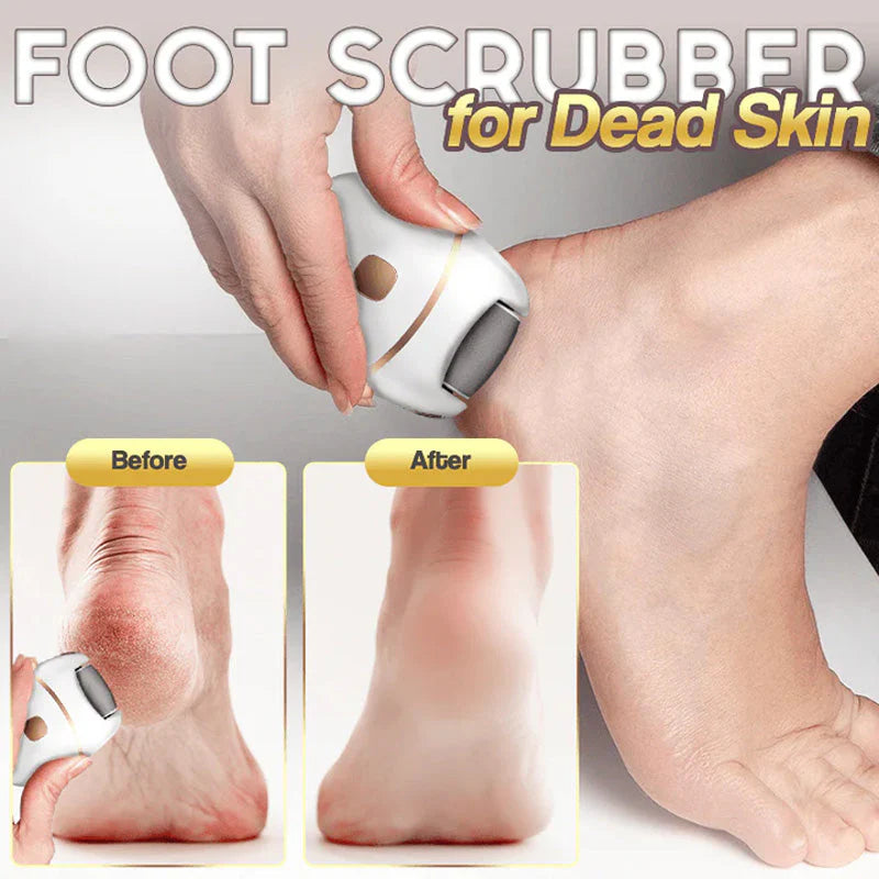 Gleam™ – Gentle Callus Remover for Smooth & Soft Feet [50% Off]