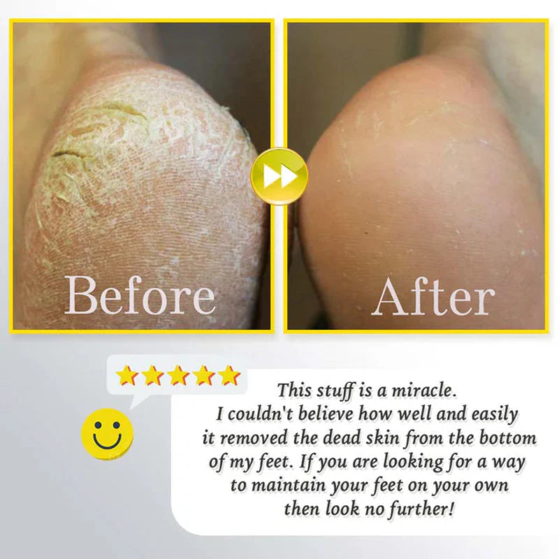 Gleam™ – Gentle Callus Remover for Smooth & Soft Feet [50% Off]