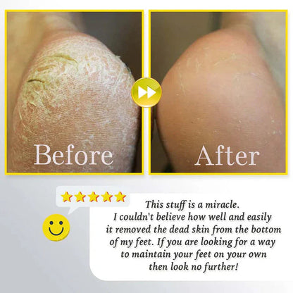 Gleam™ – Gentle Callus Remover for Smooth & Soft Feet [50% Off]