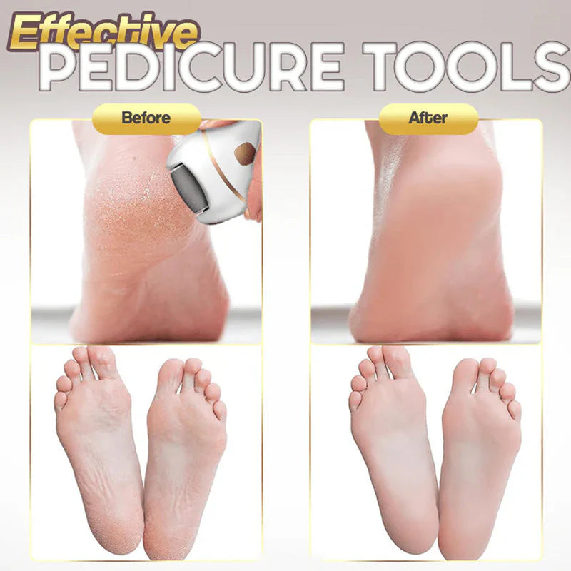 Gleam™ – Gentle Callus Remover for Smooth & Soft Feet [50% Off]