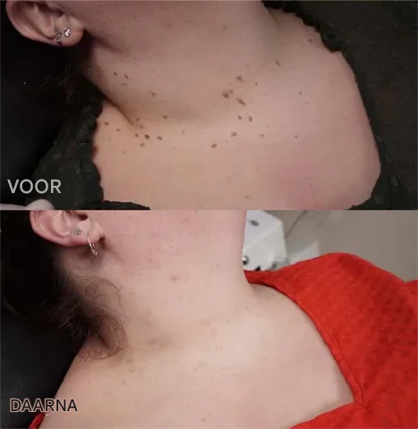 BeeNaturale™ – Gently and Effectively Removes Skin Tags and Blemishes [1 + 1 Free]
